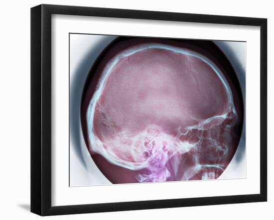 Human Skull, X-ray-Du Cane Medical-Framed Photographic Print