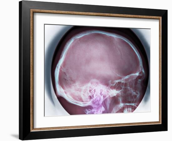 Human Skull, X-ray-Du Cane Medical-Framed Photographic Print