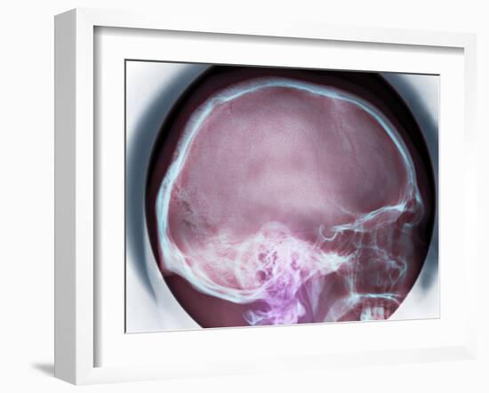 Human Skull, X-ray-Du Cane Medical-Framed Photographic Print