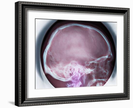 Human Skull, X-ray-Du Cane Medical-Framed Photographic Print