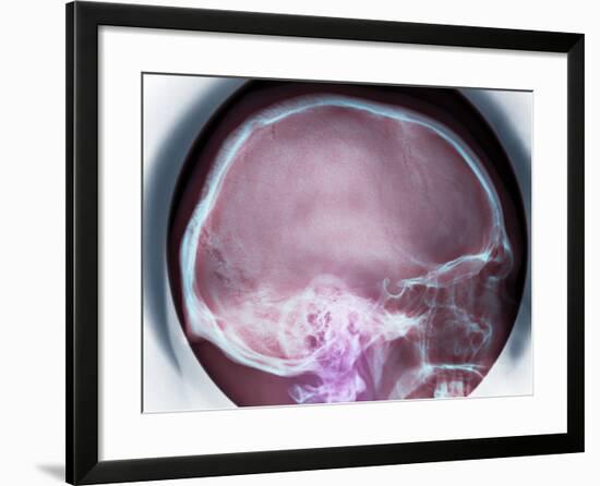 Human Skull, X-ray-Du Cane Medical-Framed Photographic Print