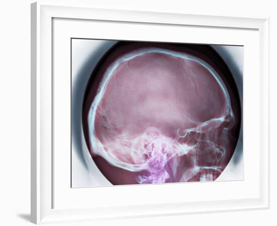 Human Skull, X-ray-Du Cane Medical-Framed Photographic Print