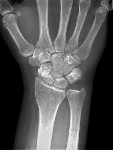 Photographic Print: Fractured Wrist, X-ray by Du Cane Medical: 12x9in