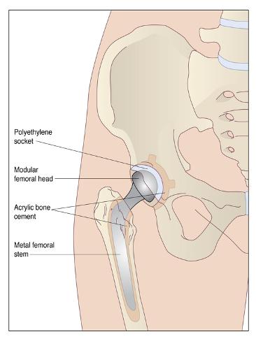 Photographic Print: Hip Replacement, Artwork by Peter Gardiner: 12x9in