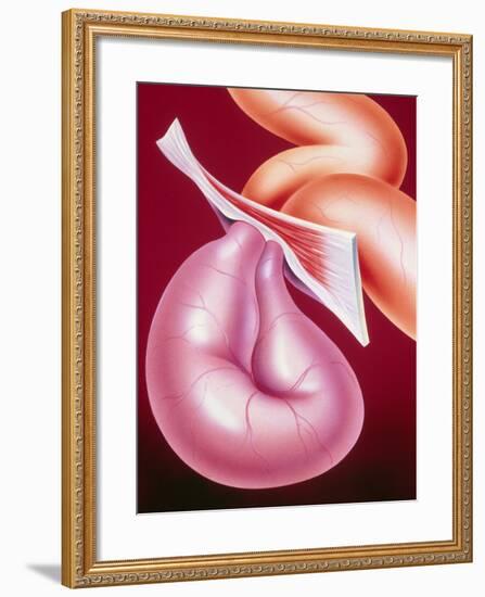 Illustration of a Strangulated Hernia-John Bavosi-Framed Photographic Print