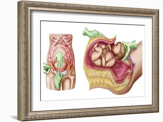 Illustration Showing Caesarean Delivery of Fetus-null-Framed Art Print