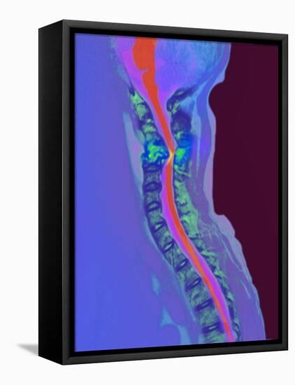 Inflamed Spinal Discs, MRI Scan-Du Cane Medical-Framed Premier Image Canvas