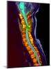 Inflamed Spinal Discs, MRI Scan-Du Cane Medical-Mounted Photographic Print