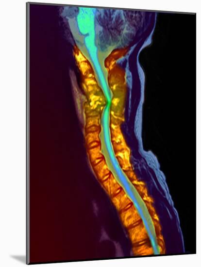 Inflamed Spinal Discs, MRI Scan-Du Cane Medical-Mounted Photographic Print