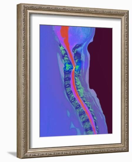 Inflamed Spinal Discs, MRI Scan-Du Cane Medical-Framed Photographic Print