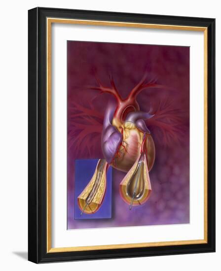 Insertion of Balloon into Atherosclerotic Artery-null-Framed Art Print