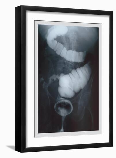 Intestine Barium-null-Framed Premium Giclee Print