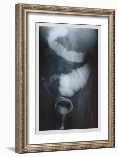 Intestine Barium-null-Framed Art Print