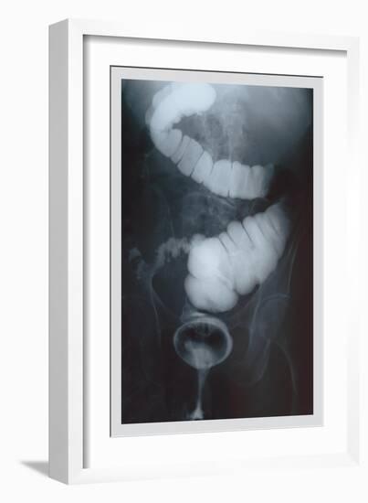 Intestine Barium-null-Framed Art Print