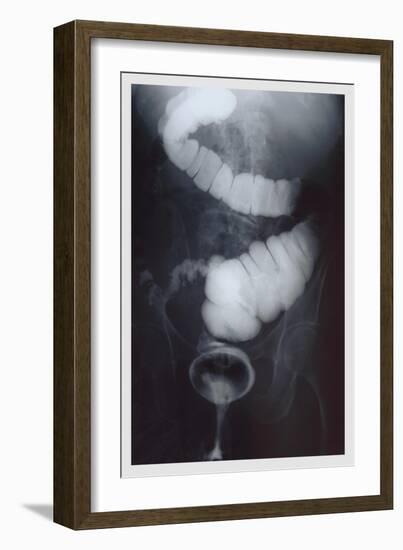 Intestine Barium-null-Framed Premium Giclee Print