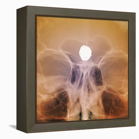 Intracranial Berry Aneurysm, X-ray-ZEPHYR-Framed Premier Image Canvas