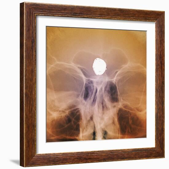 Intracranial Berry Aneurysm, X-ray-ZEPHYR-Framed Premium Photographic Print