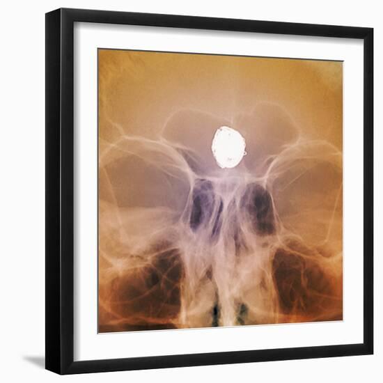 Intracranial Berry Aneurysm, X-ray-ZEPHYR-Framed Premium Photographic Print