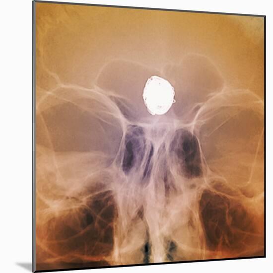 Intracranial Berry Aneurysm, X-ray-ZEPHYR-Mounted Premium Photographic Print