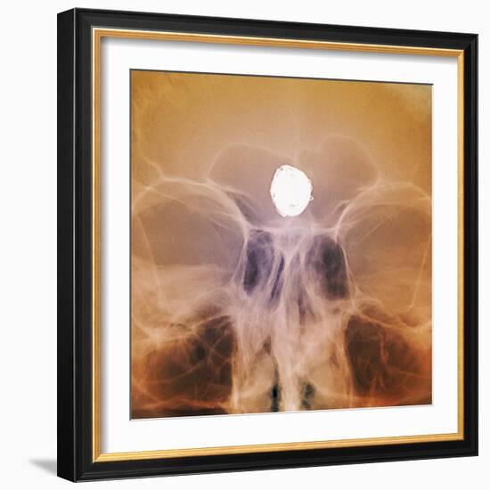 Intracranial Berry Aneurysm, X-ray-ZEPHYR-Framed Premium Photographic Print