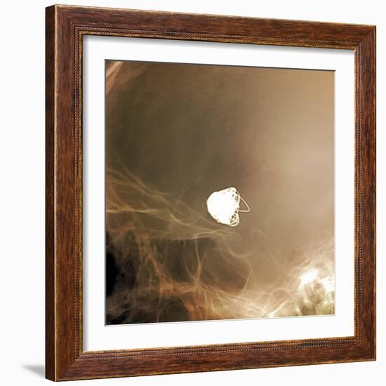 Intracranial Berry Aneurysm, X-ray-ZEPHYR-Framed Premium Photographic Print