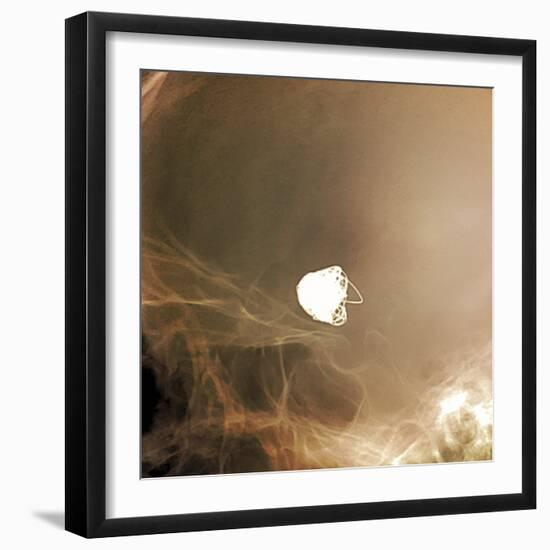 Intracranial Berry Aneurysm, X-ray-ZEPHYR-Framed Premium Photographic Print