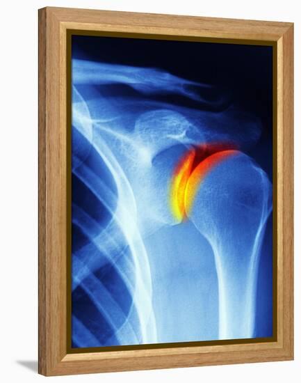 Joint Disease, CT Scan-PASIEKA-Framed Premier Image Canvas