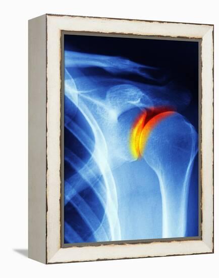 Joint Disease, CT Scan-PASIEKA-Framed Premier Image Canvas