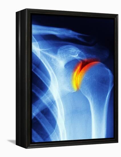 Joint Disease, CT Scan-PASIEKA-Framed Premier Image Canvas