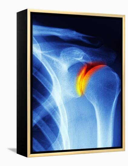 Joint Disease, CT Scan-PASIEKA-Framed Premier Image Canvas