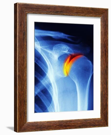 Joint Disease, CT Scan-PASIEKA-Framed Photographic Print