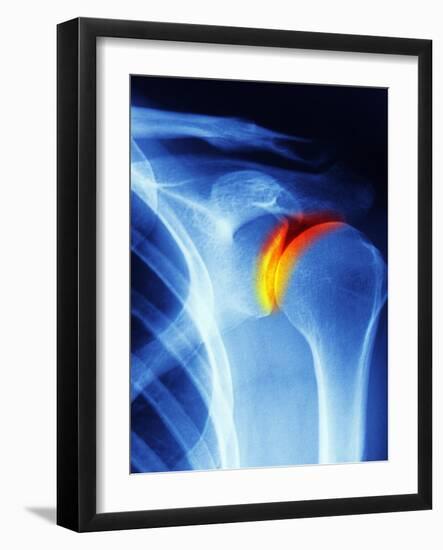 Joint Disease, CT Scan-PASIEKA-Framed Photographic Print