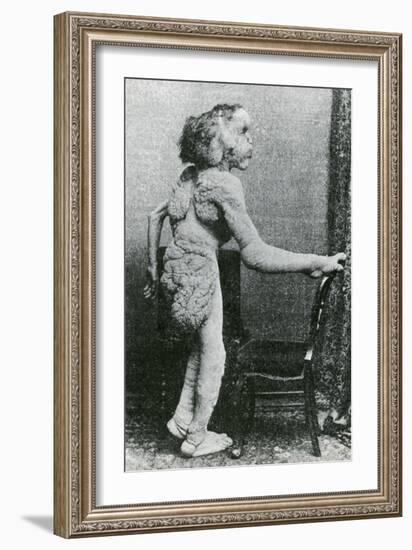 Joseph Merrick, The Elephant Man-Science Source-Framed Giclee Print