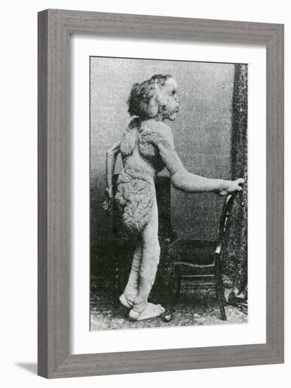 Joseph Merrick, The Elephant Man-Science Source-Framed Giclee Print