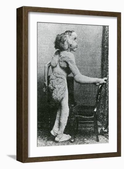 Joseph Merrick, The Elephant Man-Science Source-Framed Giclee Print