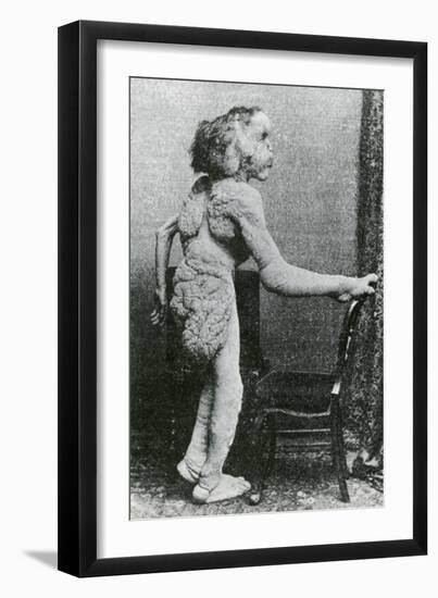 Joseph Merrick, The Elephant Man-Science Source-Framed Giclee Print