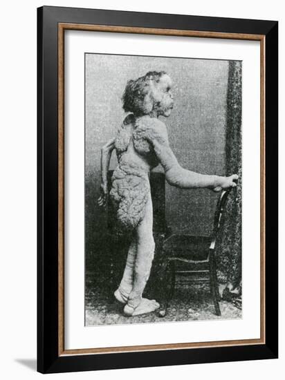 Joseph Merrick, The Elephant Man-Science Source-Framed Giclee Print