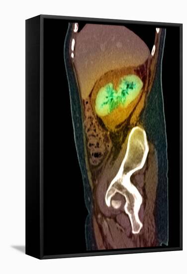 Kidney Damage, CT Scan-Du Cane Medical-Framed Premier Image Canvas