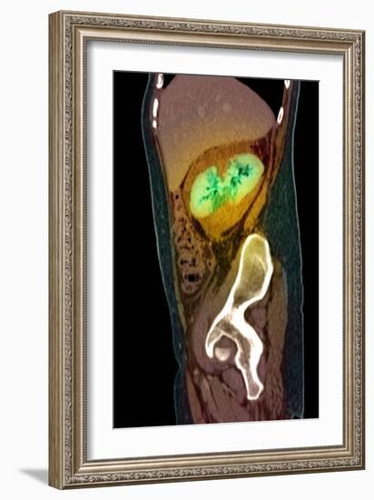 Kidney Damage, CT Scan-Du Cane Medical-Framed Photographic Print