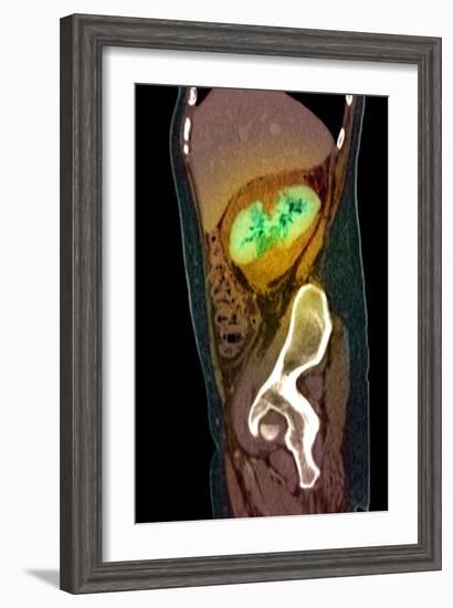 Kidney Damage, CT Scan-Du Cane Medical-Framed Photographic Print