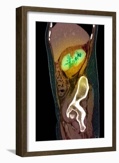 Kidney Damage, CT Scan-Du Cane Medical-Framed Photographic Print