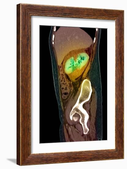 Kidney Damage, CT Scan-Du Cane Medical-Framed Photographic Print