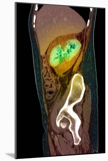 Kidney Damage, CT Scan-Du Cane Medical-Mounted Photographic Print