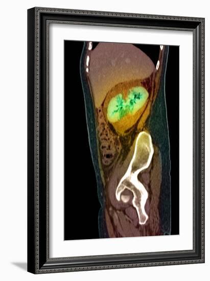 Kidney Damage, CT Scan-Du Cane Medical-Framed Photographic Print