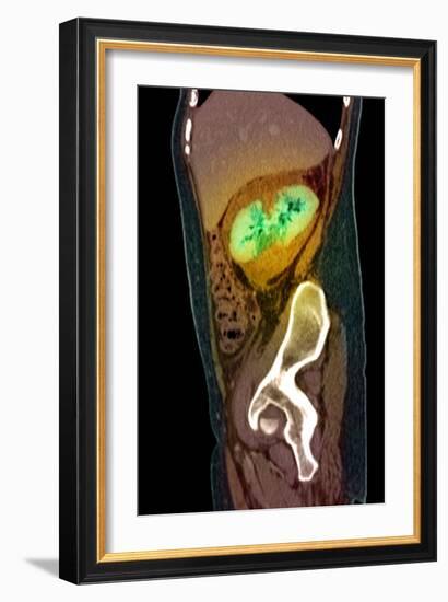 Kidney Damage, CT Scan-Du Cane Medical-Framed Photographic Print