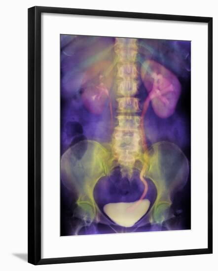 Kidney Stone In Ureter-Science Photo Library-Framed Photographic Print