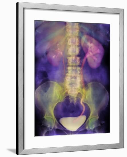 Kidney Stone In Ureter-Science Photo Library-Framed Photographic Print