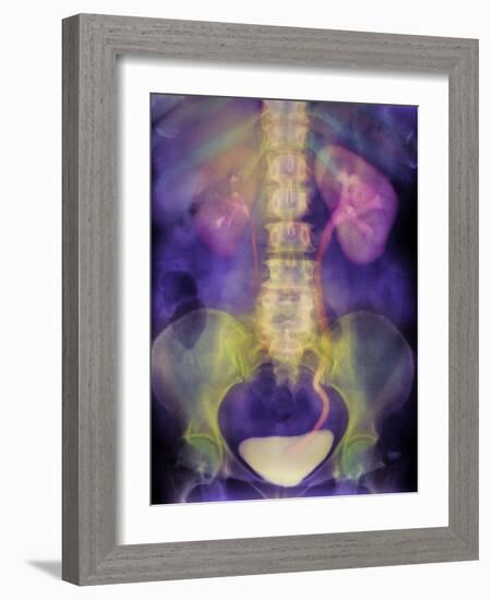 Kidney Stone In Ureter-Science Photo Library-Framed Photographic Print