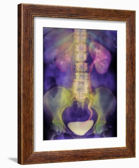 Kidney Stone In Ureter-Science Photo Library-Framed Photographic Print