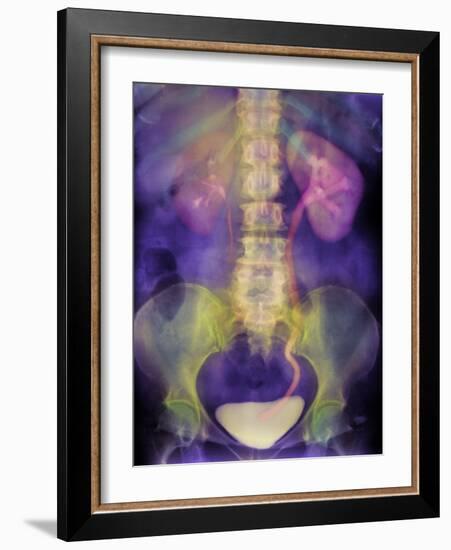 Kidney Stone In Ureter-Science Photo Library-Framed Photographic Print